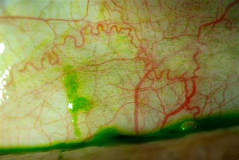 tear test for dry eyes|conjunctival staining with dry eyes.